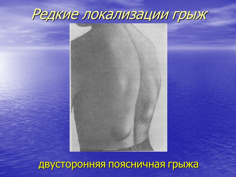 Редкие локализации грыж двусторонняя поясничная грыжа